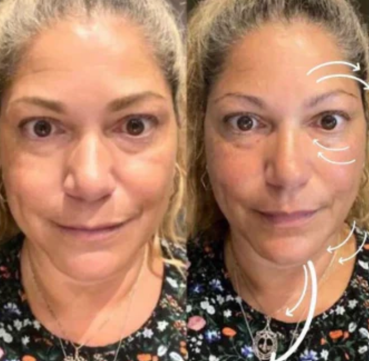 LymphLift™ Brush